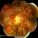 Ocular Lymphoma